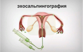 Памятка пациентам перед проведением исследования проходимости маточных труб.
